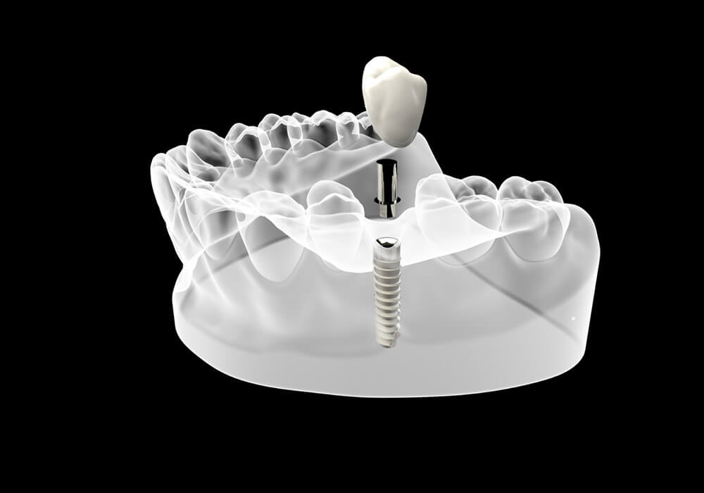 single implants available at The Tooth Place