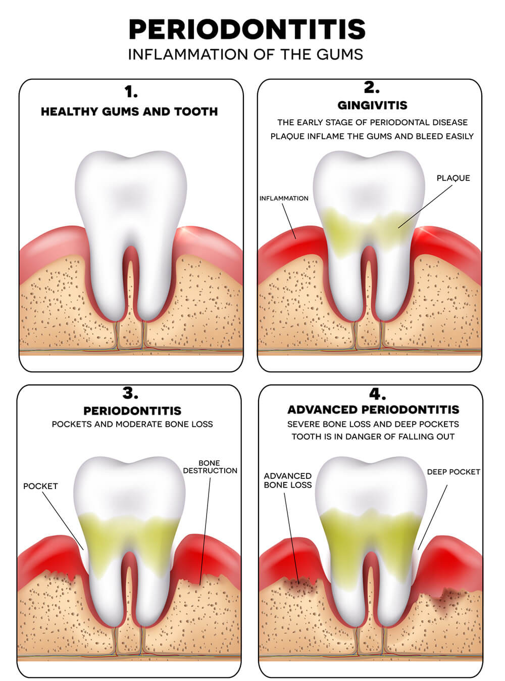 Periodontitis gum disease treated at the tooth place