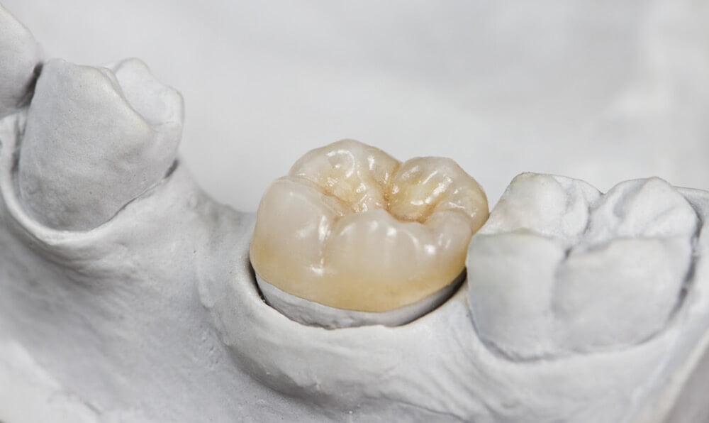 Porcelain Crowns available at The Tooth Place