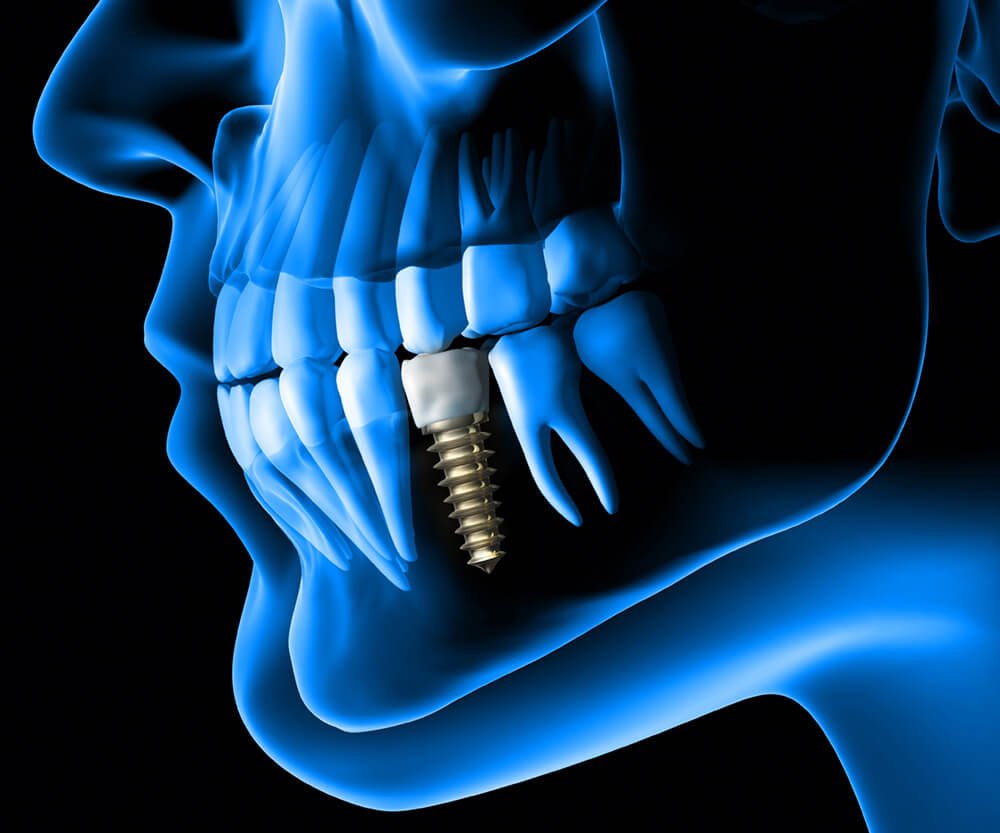 single implant treatment available at The Tooth Place